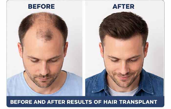 before and after results of hair transplant