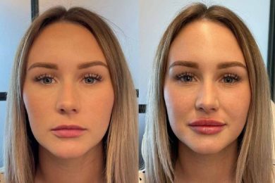 Lip Fillers Before And After